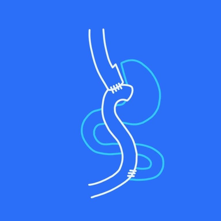 Representación de bypass gastrico