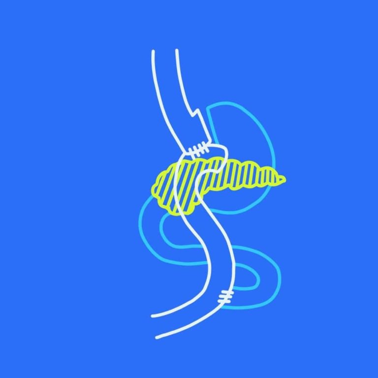 Cirujanos en quirofano realizando proceso bariatrico