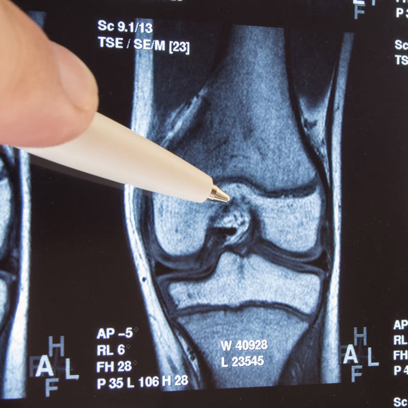Radiografía de rodilla
