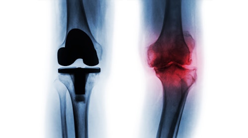 Knee Replacement Surgery in Monterrey México